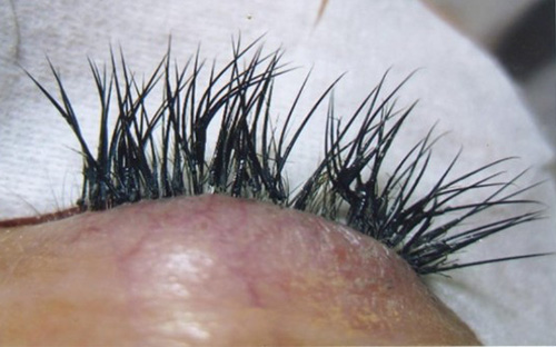 verklebte Wimpern das Lid ist entzündet