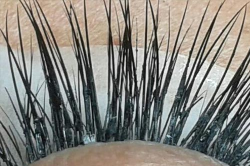 verklebte Wimpern nach einer Wimpernverlängerung.Ein Auschnitt des Auges.